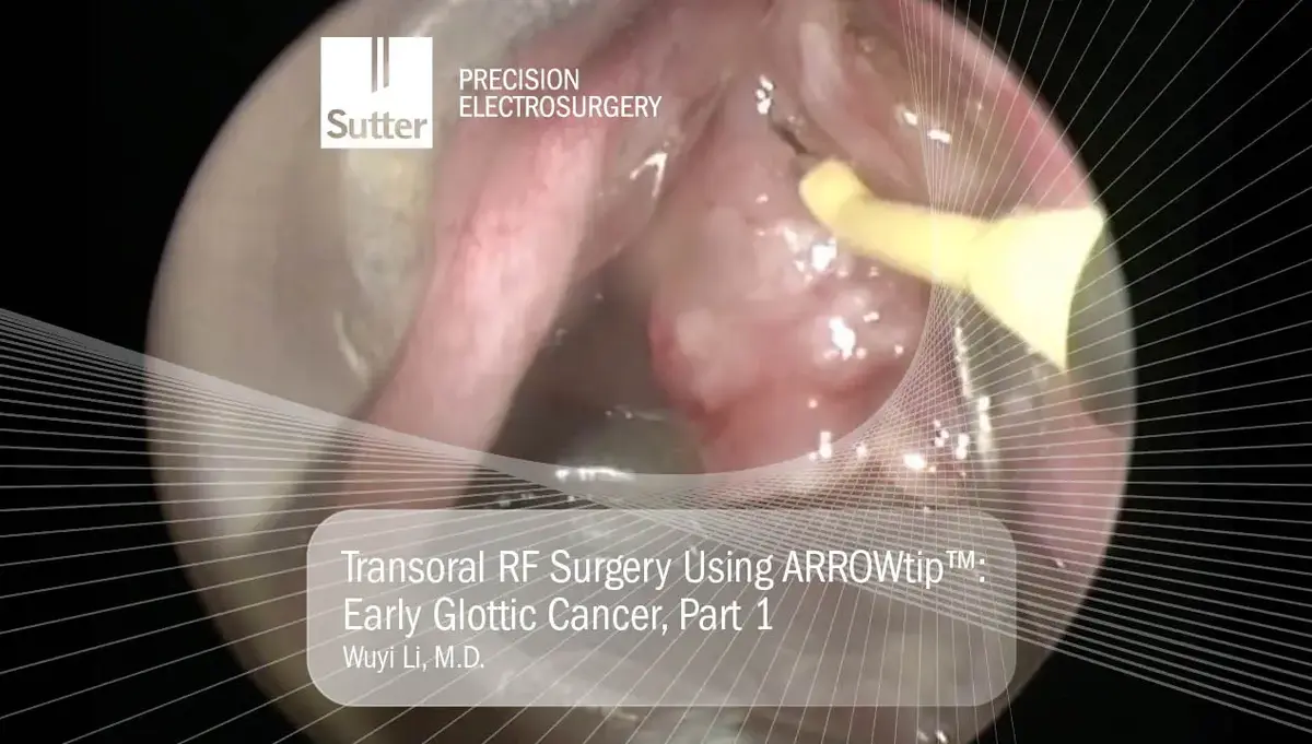 Endoskopische Ansicht einer transoralen Radiofrequenz-Operation mit der ARROWtip™ Elektrode zur Behandlung eines frühen Glottiskarzinoms.