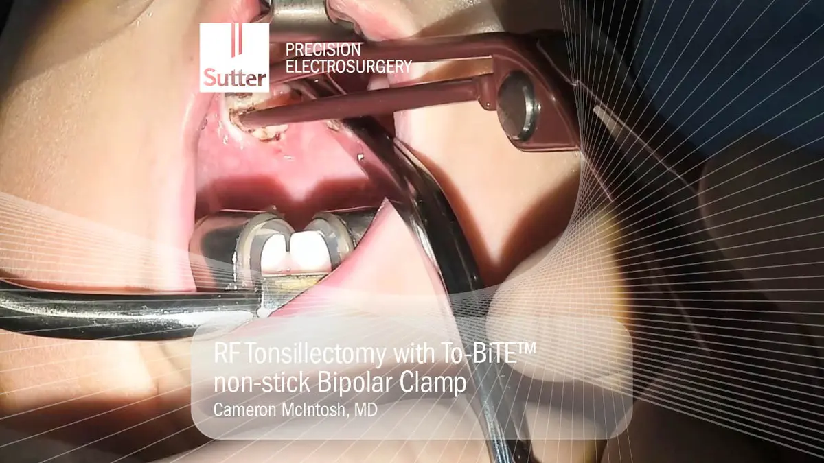 Intraoperative Darstellung einer Tonsillektomie mit To-BiTE non-stick bipolarer Zange
