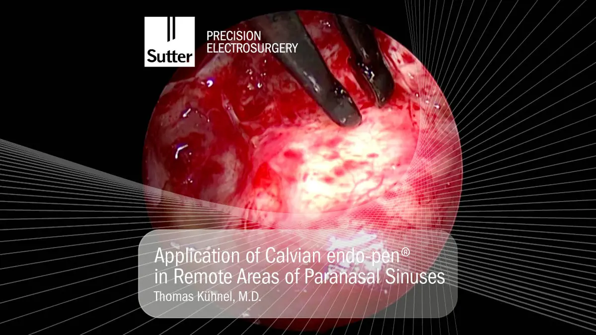 Surgical view showing the application of Calvian endo-pen® in the remote areas of the paranasal sinuses by Thomas Kühnel, M.D.