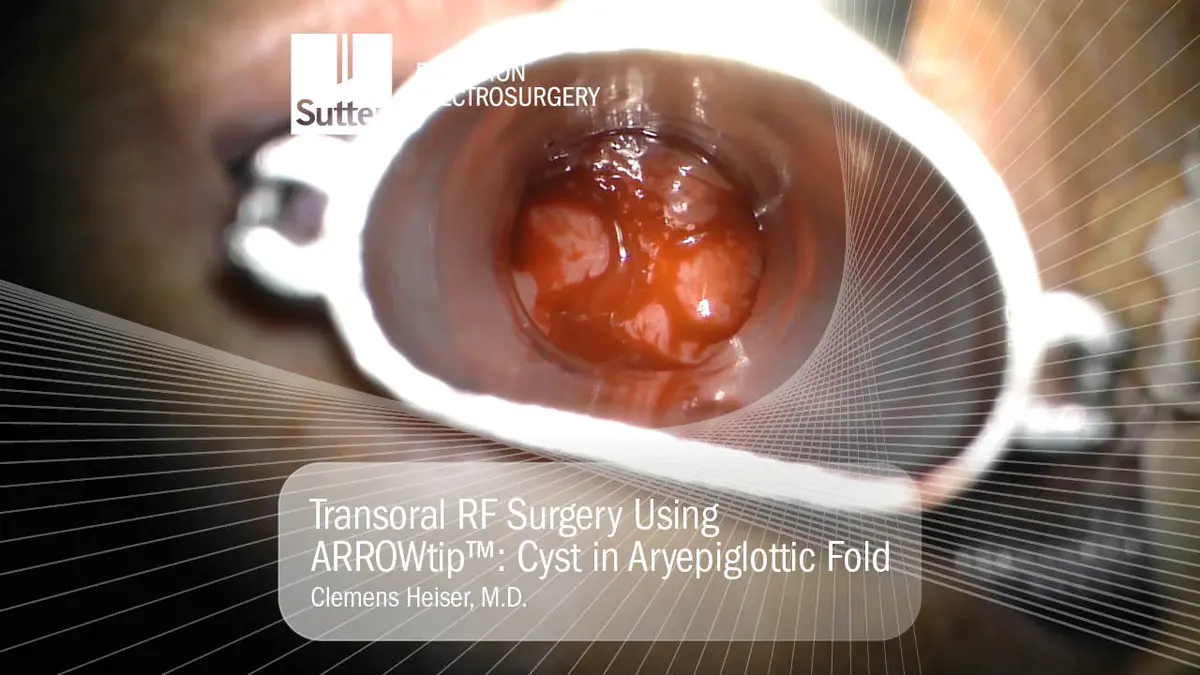 Transorale RF-Chirurgie mit ARROWtip™ zur Behandlung einer Zyste in der Aryepiglottischen Falte, durchgeführt von Dr. Clemens Heiser