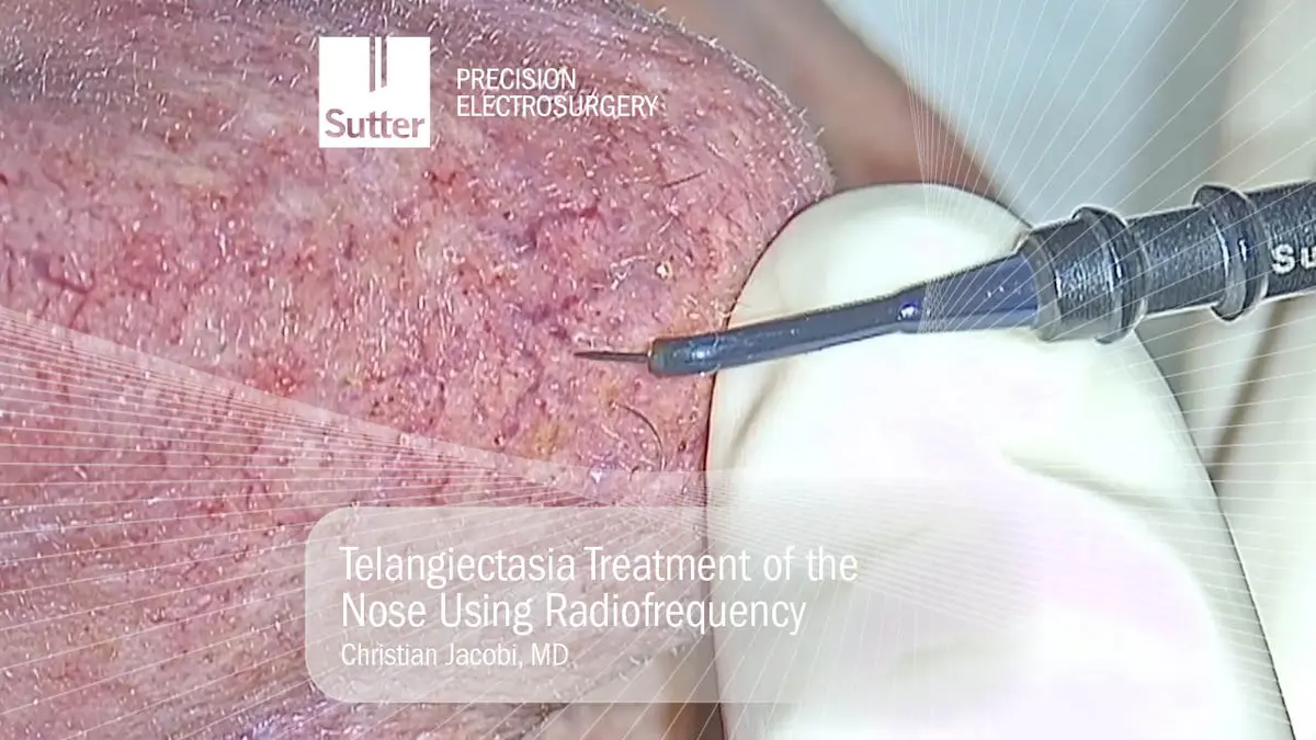 Radiofrequenzbehandlung von Teleangiektasien an der Nase mit Präzisionselektrochirurgie, durchgeführt von Dr. Christian Jacobi