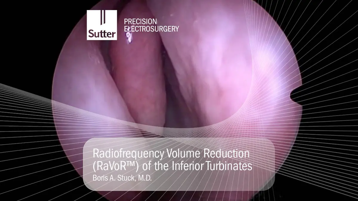 Radiofrequency volume reduction (RaVoR™) of the inferior turbinates performed by Boris A. Stuck, M.D.