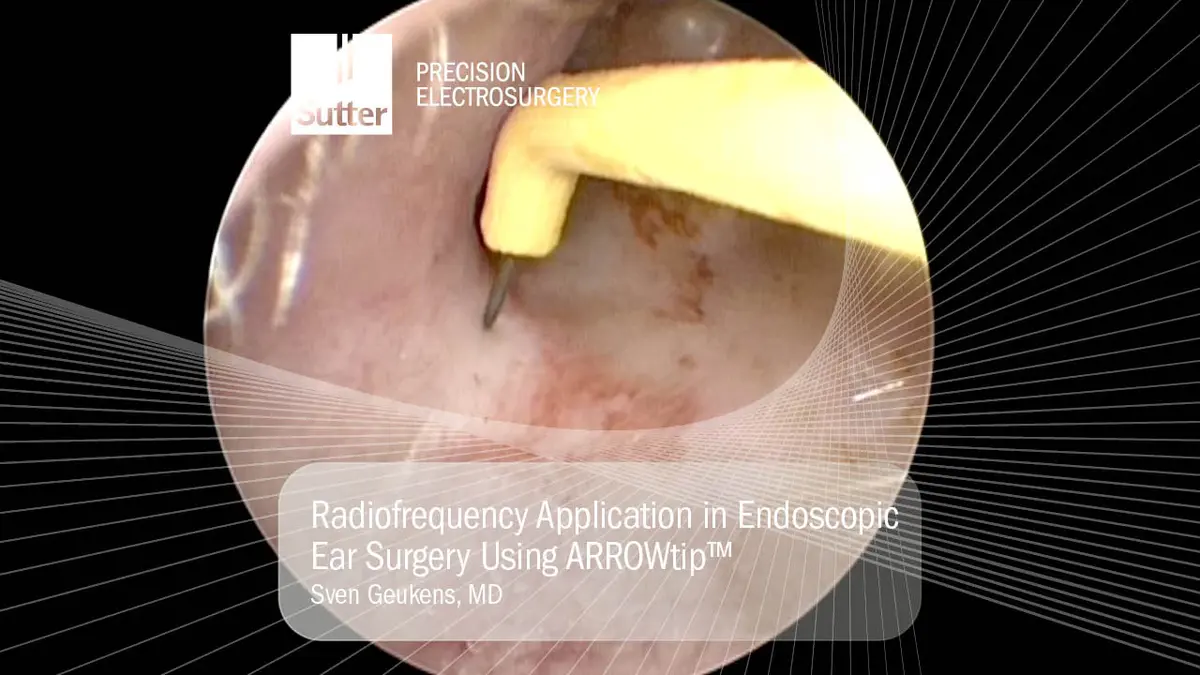 Endoskopische Aufnahme aus der Ohrchirurgie, die den Einsatz der ARROWtip™ Elektrode zur präzisen Gewebeapplikation mit Radiofrequenz zeigt; gewebeschonendes Arbeiten im Mittelohr.