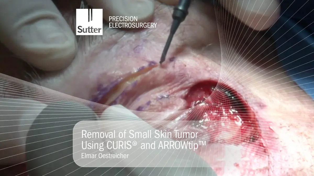 Removal of small skin tumor using CURIS® radiofrequency generator and ARROWtip™, surgical procedure by Dr. Elmar Oestreicher