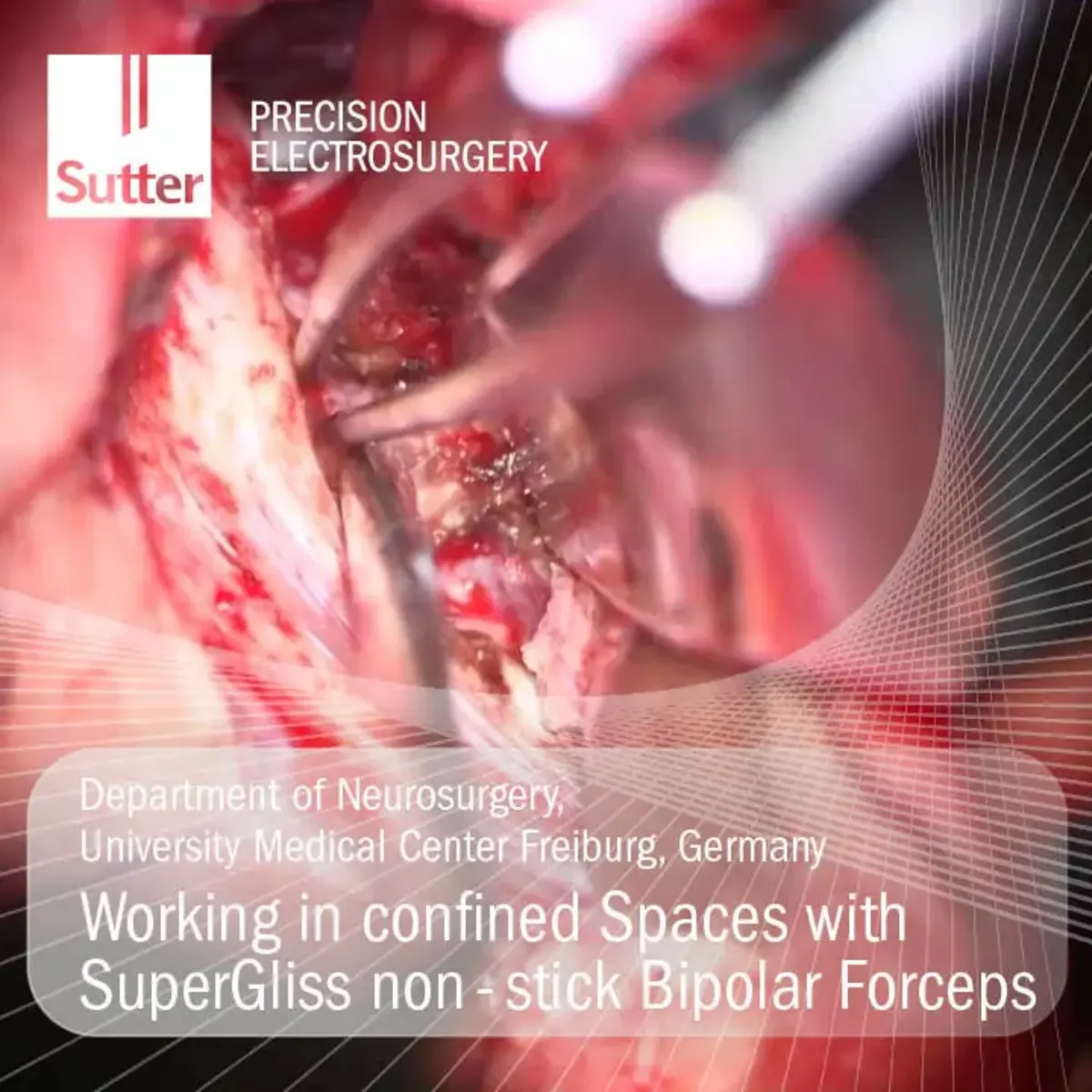 Neurosurgical procedure using SuperGliss® non-stick bipolar forceps in confined spaces at University Medical Center Freiburg