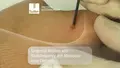 Application of radiofrequency and monopolar loop electrode for tangential ablation on skin, Sutter Precision Electrosurgery