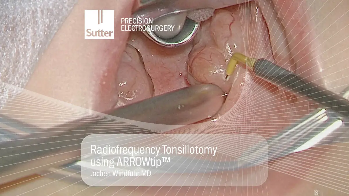 Radiofrequency tonsillotomy procedure using ARROWtip™ performed by Jochen Windfuhr, MD