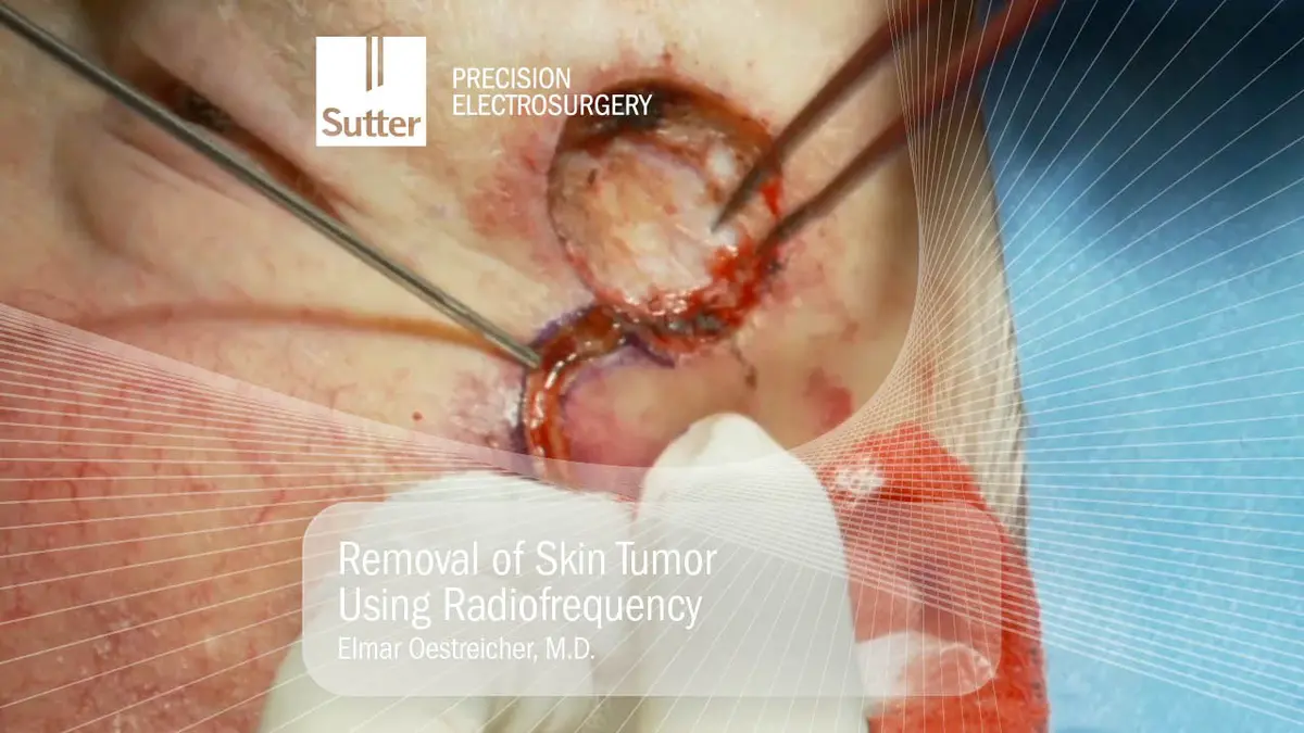 Removal of skin tumor using radiofrequency, surgical procedure by Dr. Elmar Oestreicher